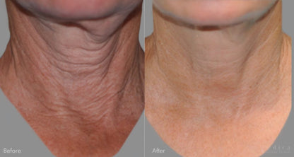 Neck Renewal Ampoule Set™