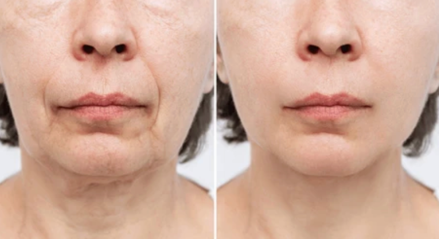 Neck Renewal Ampoule Set™