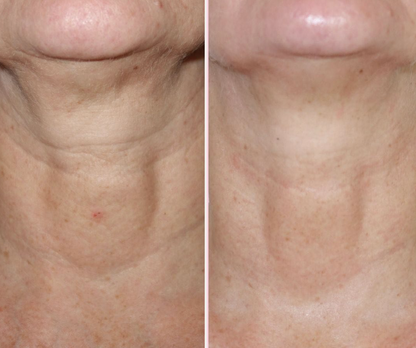 Neck Renewal Ampoule Set™