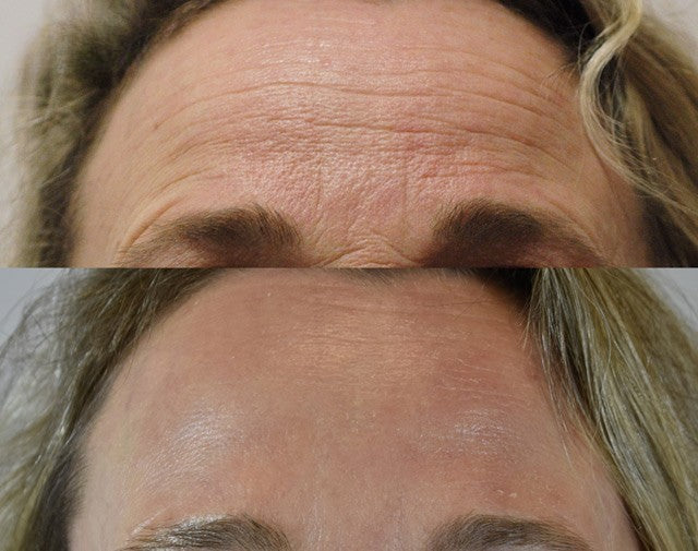 Collagen Boost (5pc Set)™